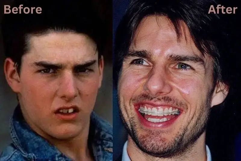 tom cruise tooth